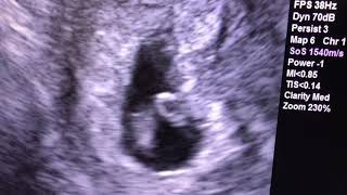 Sonogram 7 weeks pregnant [upl. by Roman]