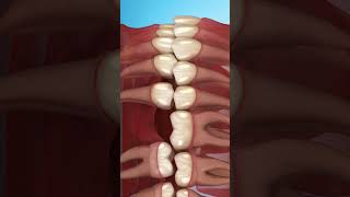 تحرك الأسنان بسبب فقدان ضرس Tooth movement due to missing tooth Surgery طبالأسنان طب [upl. by Flight969]