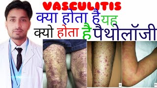 VASCULAITIS क्या है हिंदी what is vasculitis pathology [upl. by Ander292]