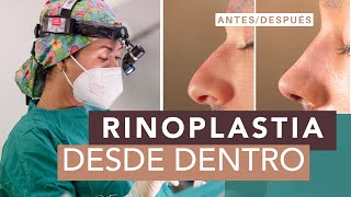 Rinoplastia Ultrasónica explicada👃🏻 Procedimiento y ventajas 🤩 [upl. by Nylitak]