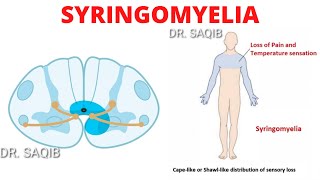 Syringomyelia [upl. by Darraj]