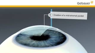 Keratoconus treatment using LIKE midstromal pocket  Lenticular Intrastromal Keratoplasty [upl. by Rushing960]