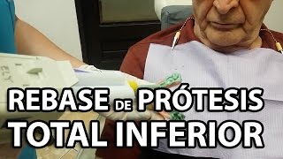 REBASE de Protesistotal 👅Inferior protesisdentales [upl. by Ynnaj591]