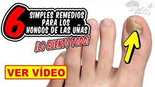 COMO ELIMINAR LOS HONGOS DE LAS UÑAS DE LOS PIES Y MANOS CON ESTOS SIMPLES REMEDIOS CASEROS [upl. by Dnomar]