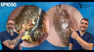 THICK EAR WAX PLUG REMOVED FROM PATIENTS EAR  EP1050 [upl. by Stevens350]