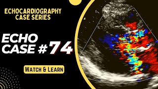 ECHO CASE 74  Echocardiography spot diagnosis Series  Echocardiogram Reporting  Echo Board [upl. by Itsirk616]