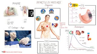 INFARCTUS DU MYOCARDE IDM  PHYSIOPATHOLOGIE ET DIAGNOSTIC [upl. by Nosyaj]