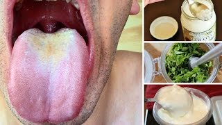 Best Home Remedies for Oral Thrush [upl. by Sucramel23]