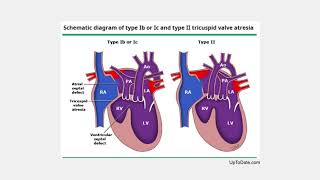 Bonus Lecture Tricuspid Atresia and QpQs 12 [upl. by Aikyn850]