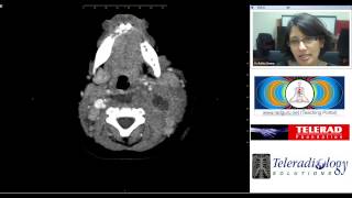 Retropharyngeal Abscess CT study by Dr Rekha Swamy [upl. by Hernardo488]