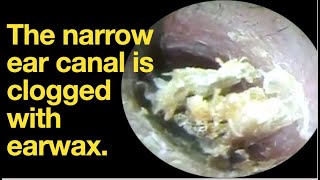 The narrow ear canal is clogged with earwaxear wax removal  ear cleaning  ASMR  relaxation [upl. by Yurt2]