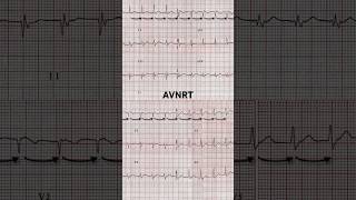 AVNRT ECG Regular and rapid rate [upl. by Liakim]