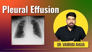 Pleural Effusion  FMGE Jan 2024 by drvaibhavahuja [upl. by Yatnohs561]