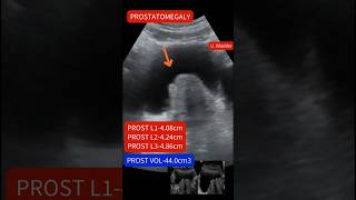 Ultrasound showing Enlarged prostateprostatomegaly ultrasound [upl. by Onilegna115]