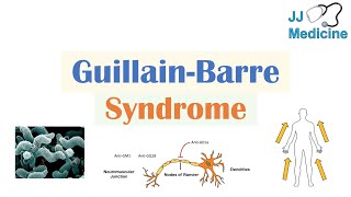 GuillainBarré Syndrome GBS  Causes Pathophysiology Signs amp Symptoms Diagnosis Treatment [upl. by Liemaj]