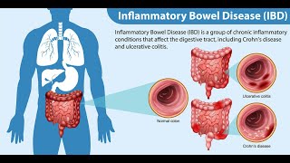 chapter2 inflammatory bowel diseaseIBD [upl. by Elleinad]