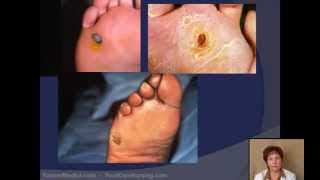 Corn amp Callus Debridement by a Podiatrist [upl. by Attenehs]