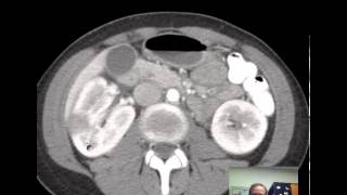 CT Kidneys and Bladder  Five pathologic cases discussed [upl. by Aramen172]