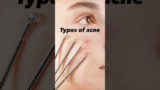 Types of acne acneskincarebeauty acneproneskin [upl. by Kinnard]