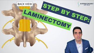 Step by step how to perform a lumbar laminectomy [upl. by Sedaiuqlem]