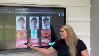 Clear Aligners Case Walkthrough [upl. by Ecinrahs455]