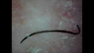 Tweezing 3 long ingrown hairs out [upl. by Goines]