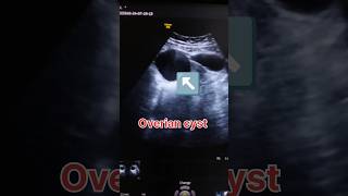 Right overian cyst ultrasound showing video medical cyst shorts medicalmasti ultrasound baby [upl. by Froma660]