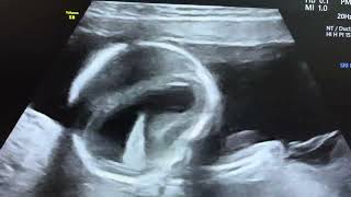 Hydrocephalus in 16 weeks fetus [upl. by Jamison]