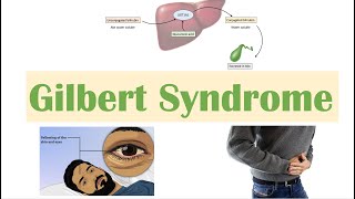 Gilbert Syndrome  Causes Genetics Pathogenesis Signs amp Symptoms Diagnosis Treatment [upl. by Joshi241]