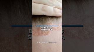 Dermatitis deborreica [upl. by Gordon]