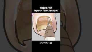 내성발톱 케어 한국인속도 Ingrown Toenail Removal [upl. by Athelstan]