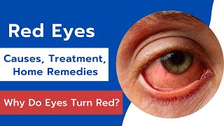 Red Eyes Causes Treatment and Home Remedies  Effective Home Remedies For Red Eyes [upl. by Elleiand720]