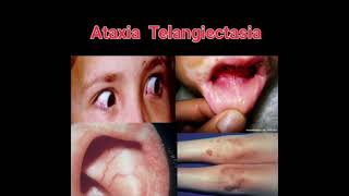 Ataxia Telangiectasia mrcpch Clinical [upl. by Neyuq999]