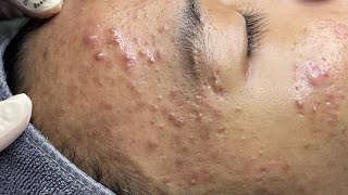 ACNE TREATMENT VU QUYNH MI  Perennial Blackheads On Boy Face 2024FULL [upl. by Puklich]