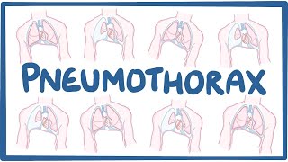 Pneumothorax  causes symptoms diagnosis treatment pathology [upl. by Aicirt]