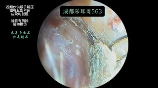 采耳哥Pitched external ear canal debris ｜563 [upl. by Lacefield578]