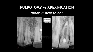 PULPOTOMY vs APEXIFICATION  When amp How [upl. by Emmet380]