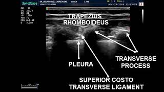 PARAVERTEBRAL BLOCK ULTRASOUND GUIDED [upl. by Toft]