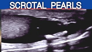 Scrotal PEARLS  Ultrasound  Causes  Association with Infertility and Oligospermia [upl. by Lemmie]