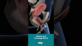 Dilation And Curettage DampC  Fertility Treatment ↪3D Medical Animation Shorts DilationampCurettage [upl. by Rothwell]