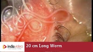 20 cm Long Worm In The Human Eye First Ever Recorded On Video  India Video [upl. by Morven]