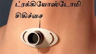 Tracheostomy in tamil ட்ரக்கியோஸ்டோமி சிகிச்சை in tamil [upl. by Randolph]