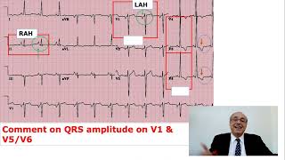 EKG Trainer Case 5 Answer [upl. by Wenger373]