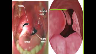 Complication of Tonsillitis  ENT [upl. by Yral]