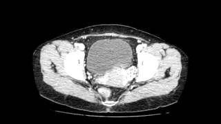 Right Paraduodenal Hernia [upl. by Rebeh]