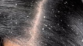 ASMR Dandruff scratchingDandruffPsoriasScalp [upl. by Annaujat86]