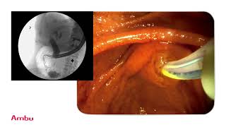 Dr Sam Serouya Performs amp Narrates a Sphincterotomy and Stent Placement Using the aScope™ Duodeno [upl. by Iover]