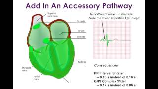 WolffParkinsonWhite WPW and Associated Arrhythmias [upl. by Aicekan902]