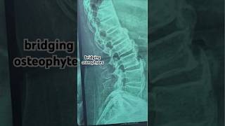 Ankylosing spondylitisBechtrewe’s diseaseAxial Spondyloarthritis xray video ultraradiology [upl. by Layod323]