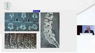 Osteoid Osteoma What Shall I Do by Dr Mohamed Fawzy Khattab [upl. by Oliver]